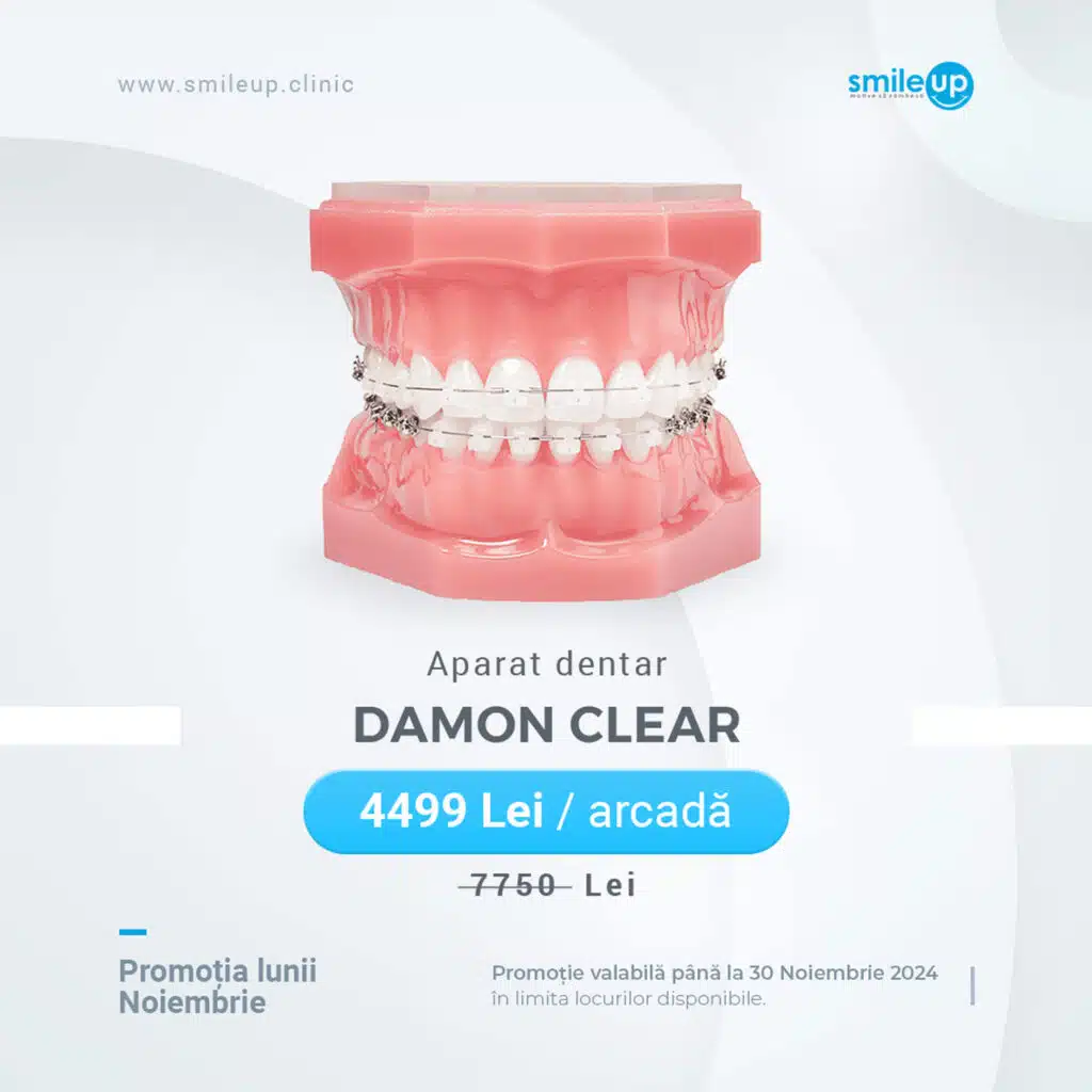 Aparat dentar Damon Clear