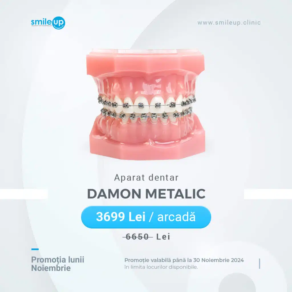 Aparat dentar Damon Metalic