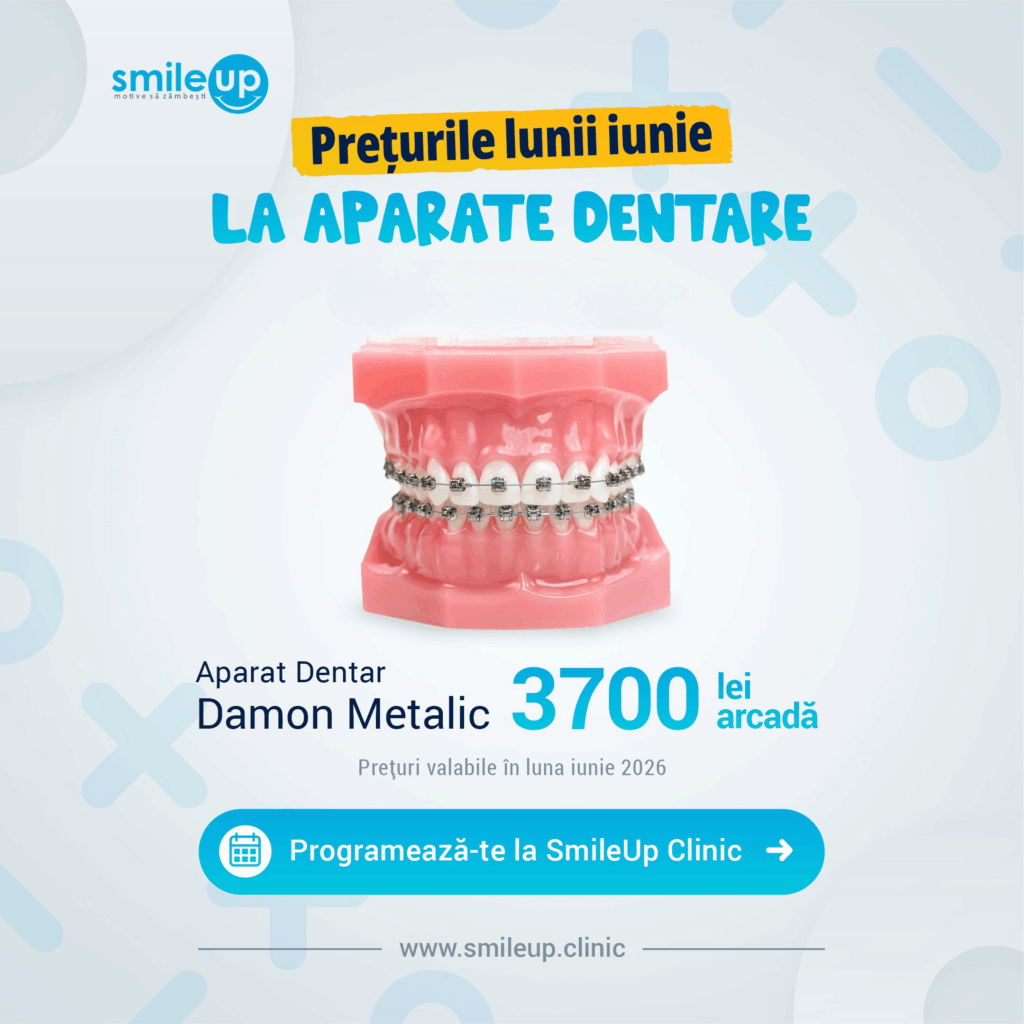 Promoție SmileUp: prețuri ale lunii iunie pentru aparate dentare, imagine cu modele dentare cu bracketuri metalice
